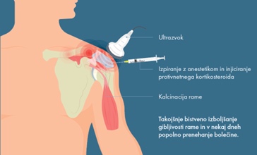 Kalcinacija rame