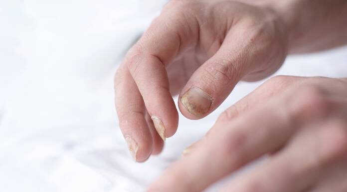 Bolezenske spremembe v barvi nohtov