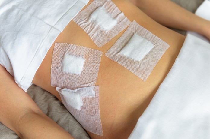 Okužba kirurških ran