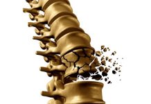 Osteoporoza je kronična bolezen