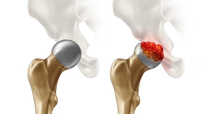 bolezen femoralne glave in osteoartritis